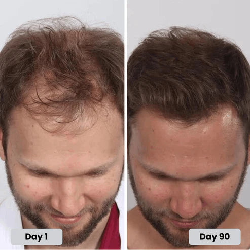 Red Light Hat - Get Your Hair & Confidence Back