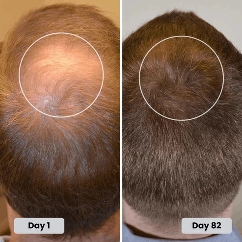 Red Light Hat - Get Your Hair & Confidence Back